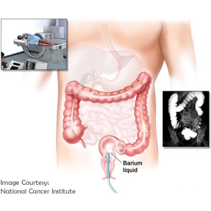 Barium Enemas Cancerquest