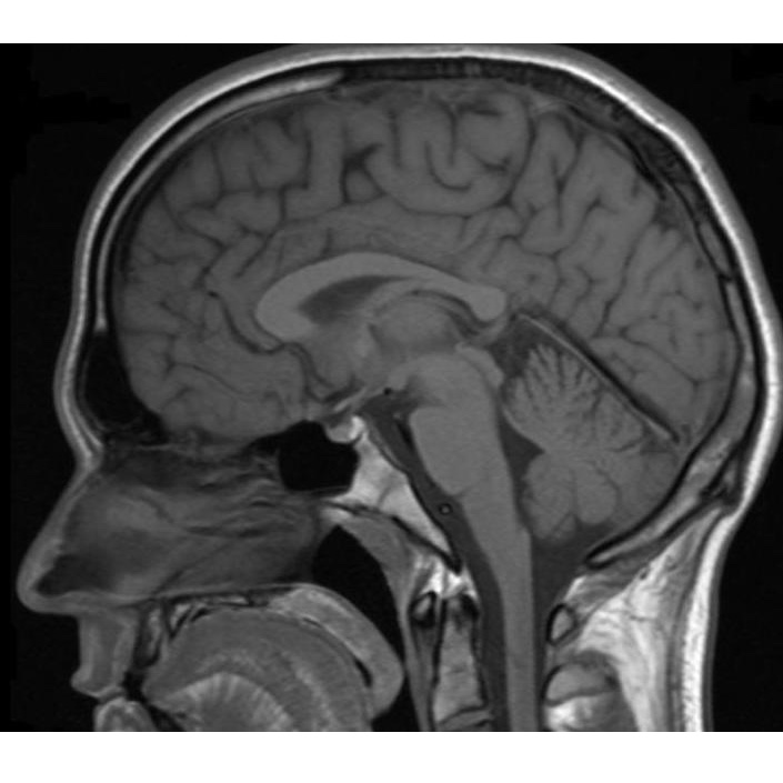 Brain MRI: What It Is, Purpose, Procedure & Results