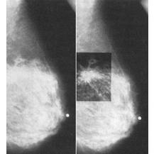 Mammography  CancerQuest