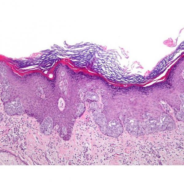 squamous cell carcinoma skin histology