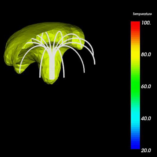 Radiofrequency Ablation (RFA) | CancerQuest