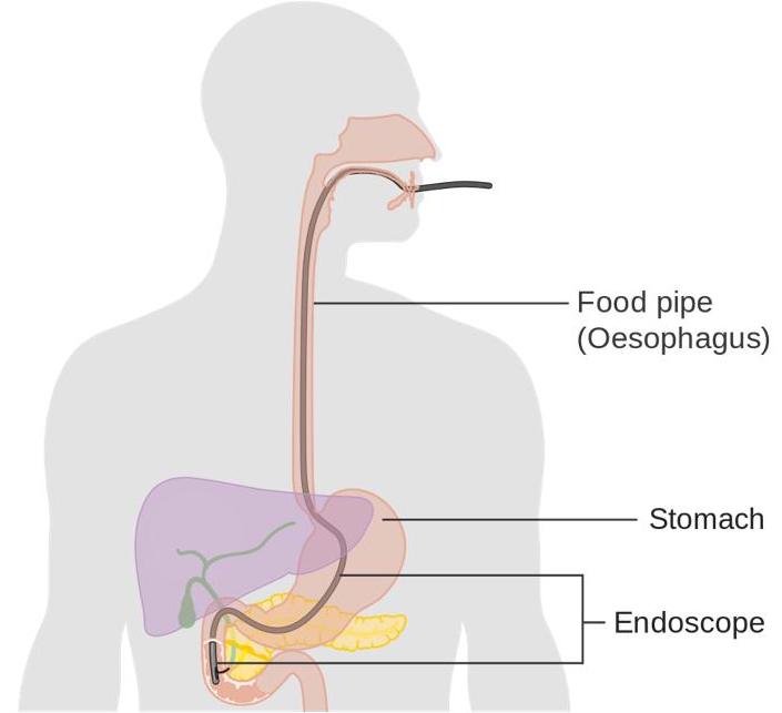 Через пищевод. . Эзофагоскопия - исследование пищевода. Эзофагоскопия мембрана пищевода.
