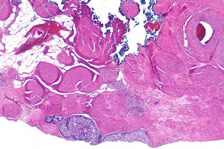 carcinogenesis initiation promotion progression