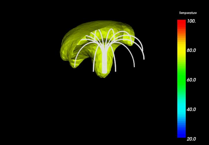 RadioFrequencyAblation.jpg