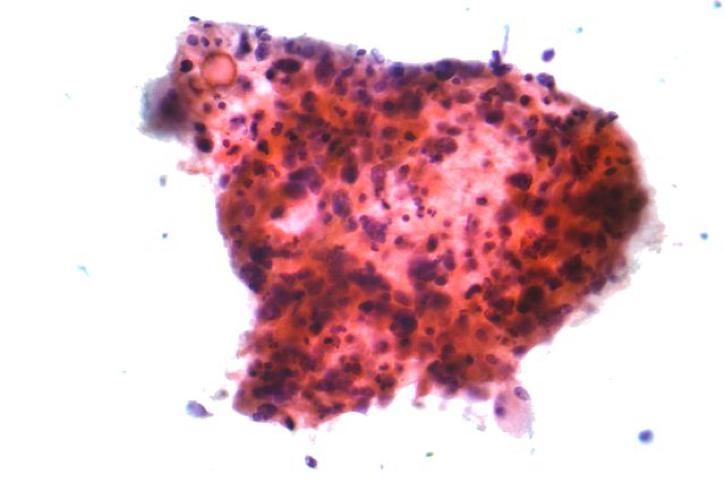 The first description of malignant cells in the sputum was reported by W.H. Washe. 1 Sputum tests are now performed to screen for lung cancer.1Long, S.R. and Cohen, M.B. "Classics in Cytology VI: The Early Cytologic Discoveries of Lionel S. Beale." Diagnostic Cytopathology. 9 (1993): 595-598. [PUBMED]      