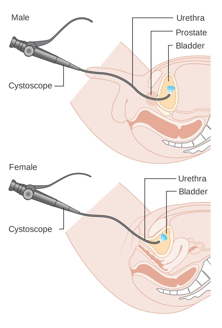 The first cystoscope, an instrument that is inserted through the urethra and used to detect cancer of the bladder, was created by Maximilian Carl Friedrich Nitze. 11Reuter, M.A., and Reuter, H.J. "The Development of the Cystoscope." The Journal of Urology. 159 (1998): 638-640. [PUBMED]      