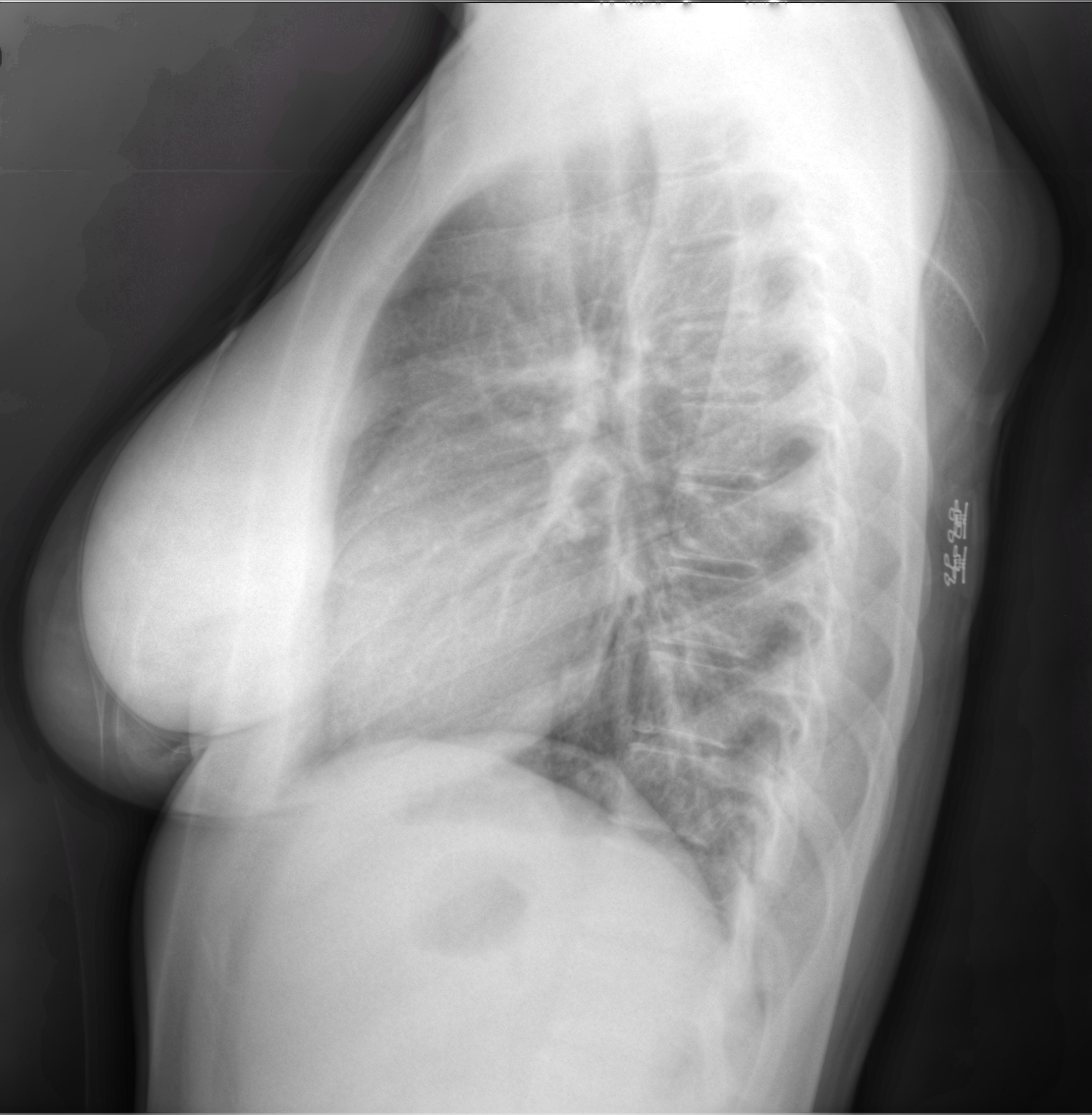 The use of x-rays for diagnostic examination of the breast was introduced in by Stafford Warren. His technique involved the patient lying on her side with her arm raised and having the picture taken from the side.1  1Warren, S.L. "A Roentgenologic Study of the Breast." The American Journal of Roentgenology and Radium Therapy. 24 (1930): 113-124.            