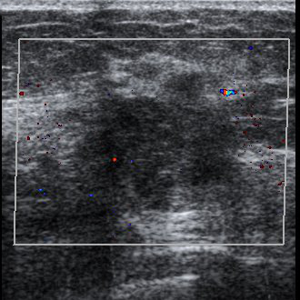 Ultrasound imaging was used for the first time for medical diagnostics, specifically the identification of intracranial tumors, by Karl and Friederich Dussik. 1  1Shampo, M.A. and Kyle, R.A. "Karl Theodore DussikPioneer in Ultrasound." Mayo Clinic Proceedings. 70 (1995): 1136. [PUBMED]            