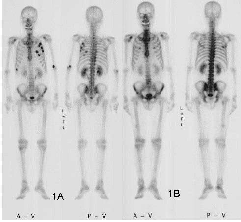 Bone scintigraphy, or photoscanning of the bone with a radioactive isotope, using Sr was performed as a diagnostic test for spinal metastases by Gynning et al. 1  1Gynning, I. et al. "Localization With Sr85 of Spinal Metastases in Mammary Cancer and Changes in Uptake After Hormone and Roentgen Therapy: A Preliminary Report." Acta Radiologica. 55 (1961): 119-128.            