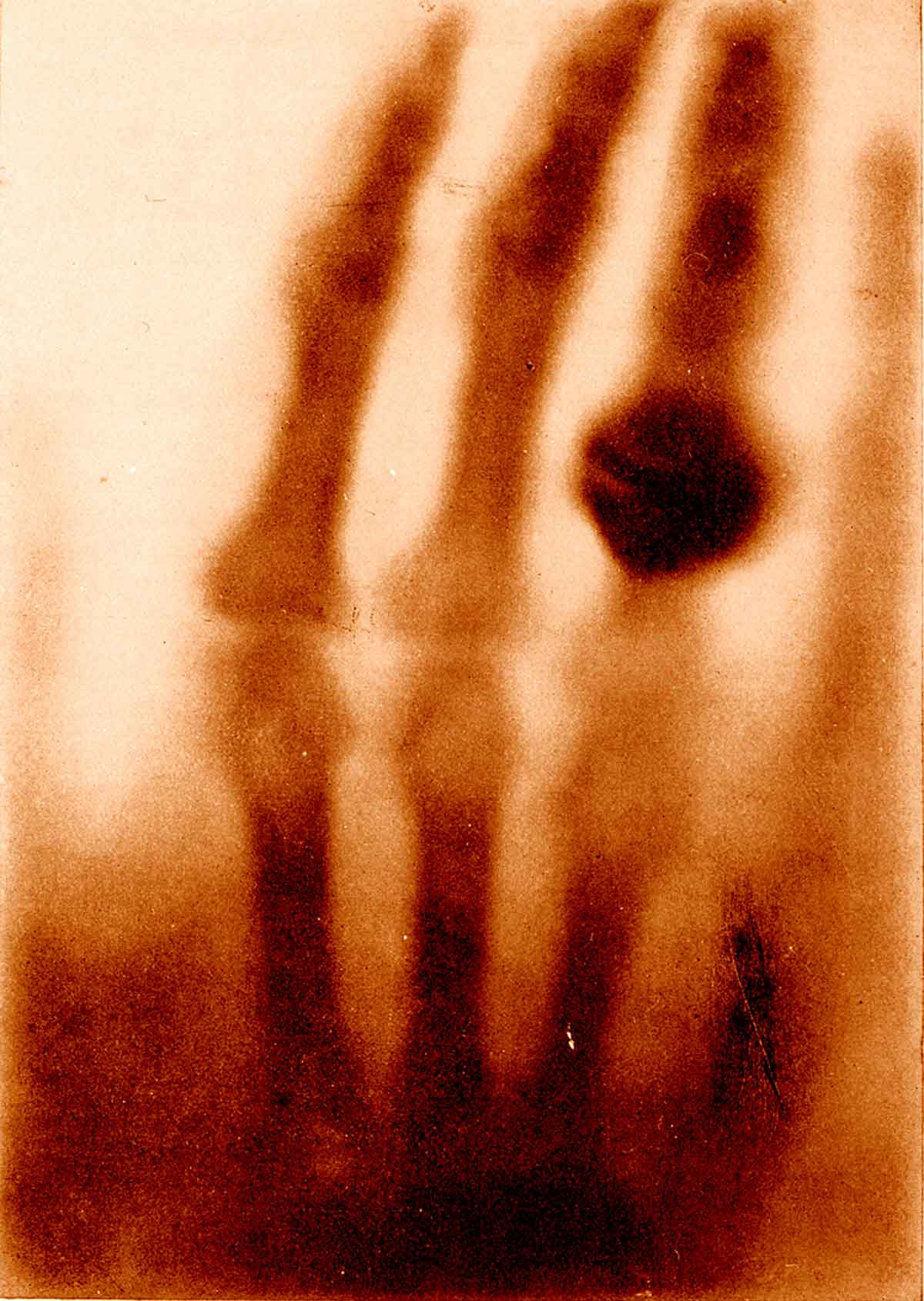 Wilhelm Conrad Roentgen discovers x-rays. This discovery is thought of as one of the greatest technological accomplishments of all time. It made a huge impact on cancer detection and treatment.Four years later (1899) Tage Anton Ultimus Sjogren successfully treats cancer with x-rays.11Morton, Leslie T., and Moore, Robert J. A Chronology of Medicine and Related Sciences. Aldershot, England: Scholar Press, 1997      