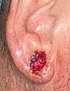 Basal Cell Carcinoma on Ear ear bcc