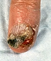 Squamous Cell Carcinoma on Finger finger nail scc