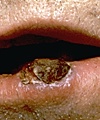 Squamous Cell Carcinoma on Lip lip scc