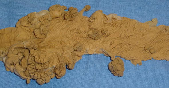 Adenomas in Colon Gross pathology colon