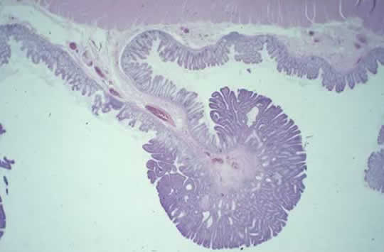 colon adenoma microscopic