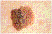 Melanoma with Large Diameter melanoma