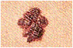 Melanoma with Irregular Border melanoma