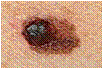 Melanoma melanoma