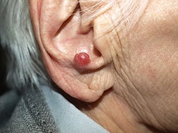 Merkel cell carcinoma