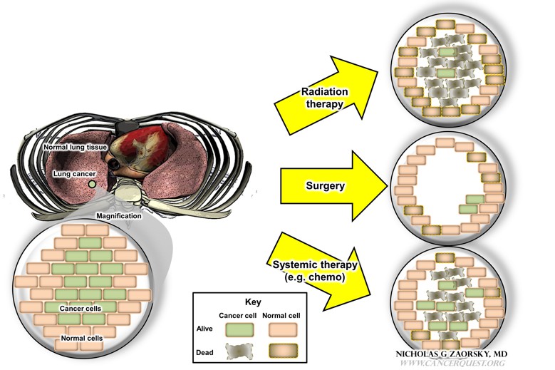 Robotic Surgery Lung Cancer Or Colon Cancer