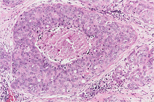 H&E stained breast cancer tissue
