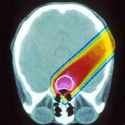 Proton beam irradiating a brain tumor (pink), seen with a CT scan