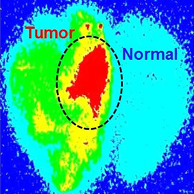 Cancer imaging showing normal and cancer tissue