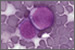 Blocking one oncogene makes leukemic stem cells revert in laboratory study.