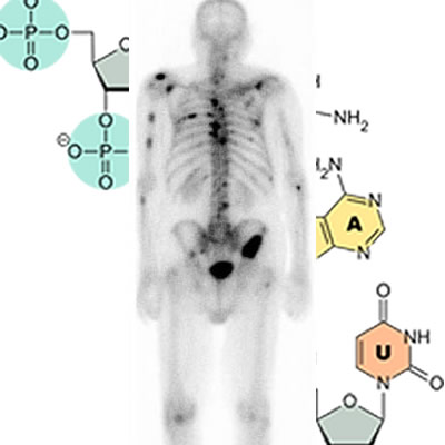 Prostate cancer CT imaging with RNA in the background