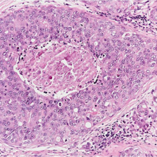 H&E stained breast cancer tissue