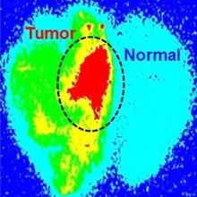Cancer imaging showing normal and cancer tissue