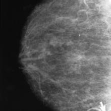 Cancer mammography.